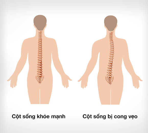 Dieu tri cong veo cot song Maple Vietnam