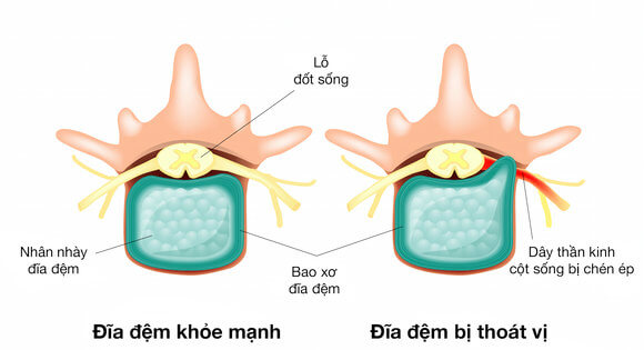 Dieu tri thoat vi dia dem loi dia dem Maple Vietnam